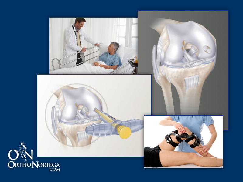 Atroscopía ed rodilla